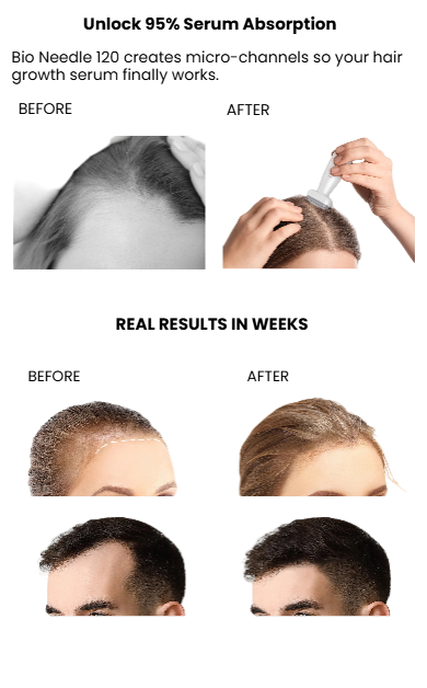 Bio Needle Adjustable Microneedle Derma Stamp